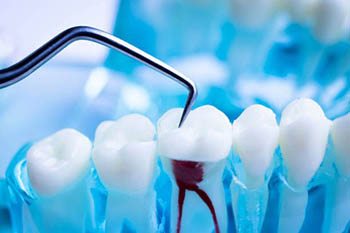Endodoncia_th